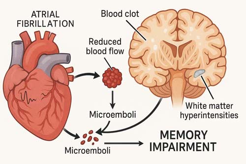 Afib and Memory