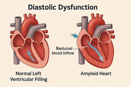 Cardiac Amyloidosis