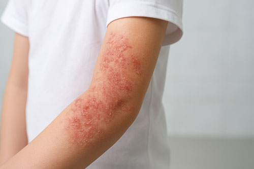 Atopic Diseases