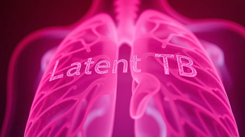 Latent TB