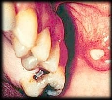 Dental Infection - Globalrph