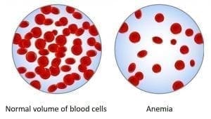 iron deficiency and anemia