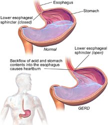 gastrointestinal disorders