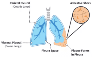 Mesothelioma