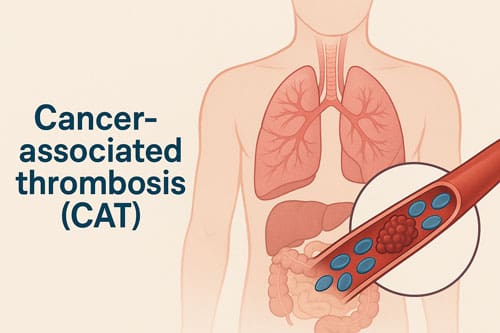 Cancer-Associated Thrombosis