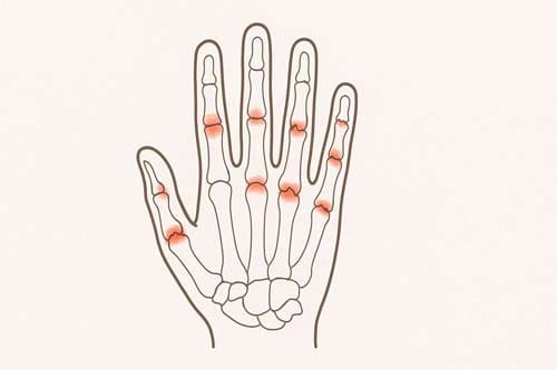 Rheumatoid Arthritis